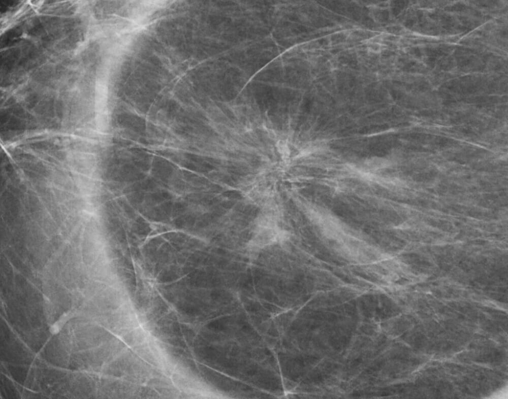 Ακτινωτή Ουλή