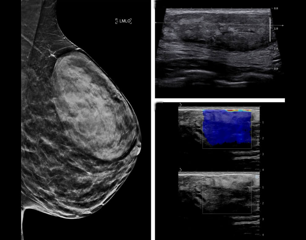 Αμάρτωμα (Ιναδενολίπωμα)