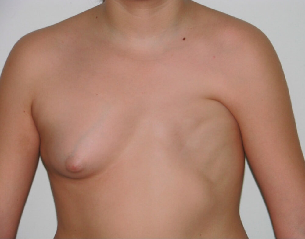 Απλασία - Υποπλασία Μαστού