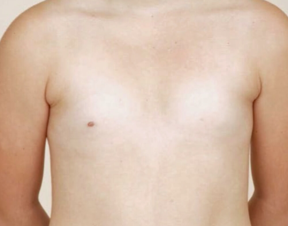 Απλασία Θηλής (Αθηλία)