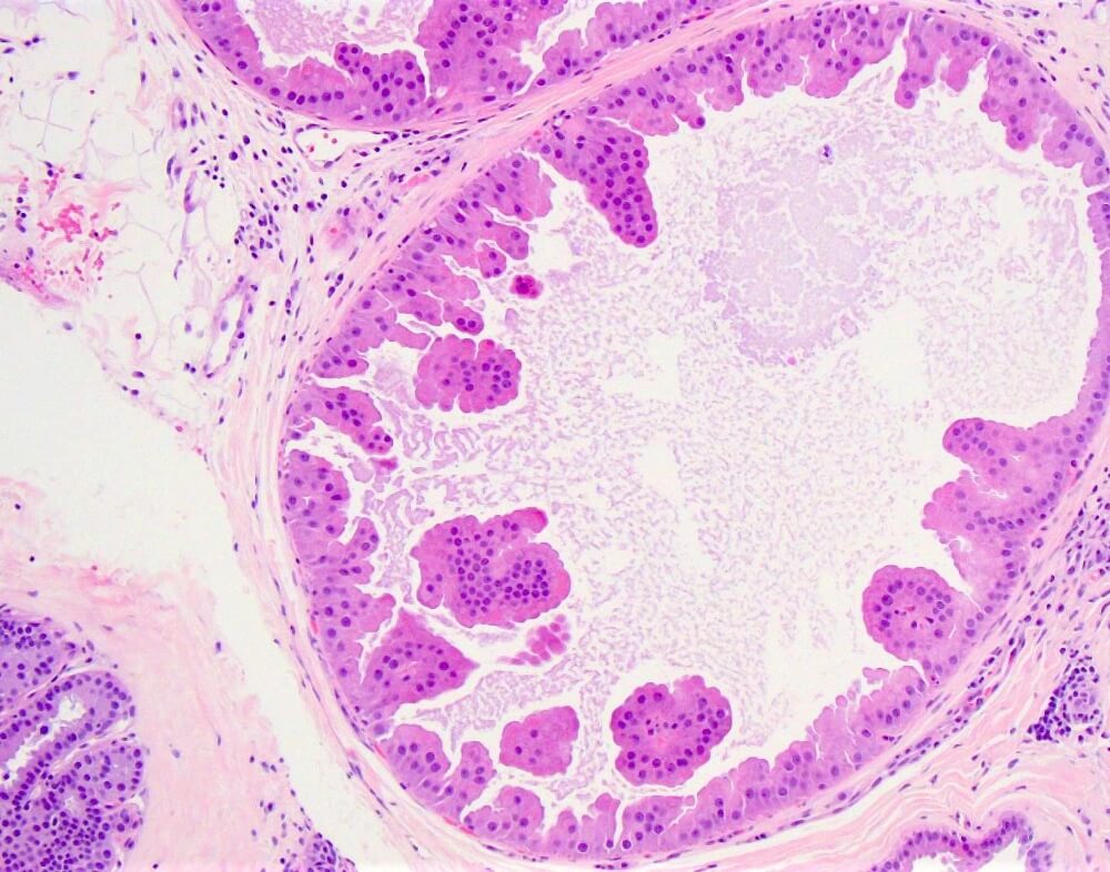 Αποκρινής Μεταπλασία