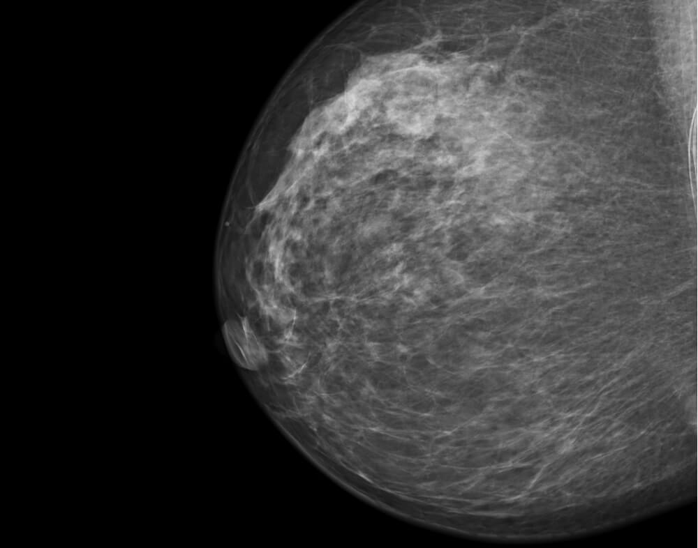 Διαβητική μαστοπάθεια