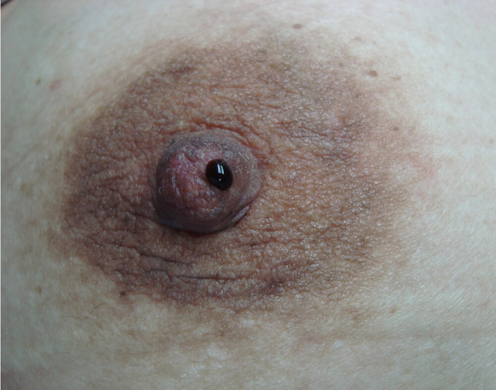 Ενδοπορικό Θήλωμα