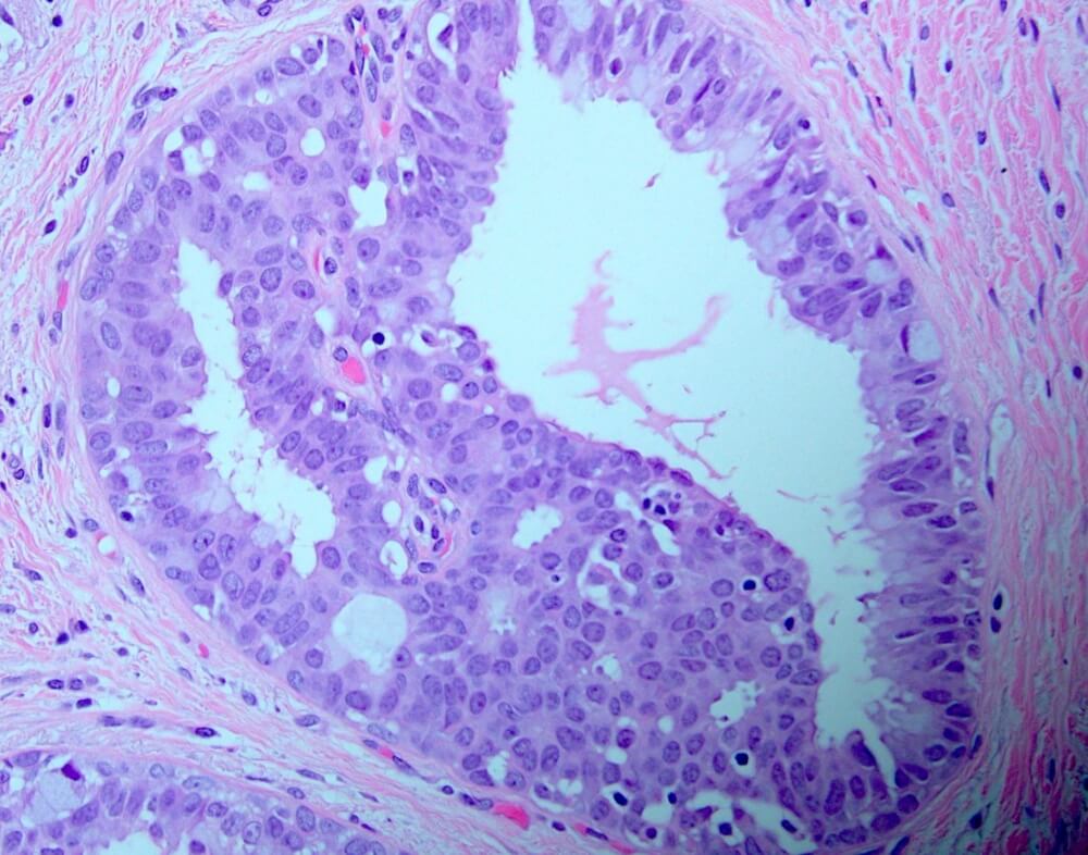 Επιθηλιακή υπερπλασία