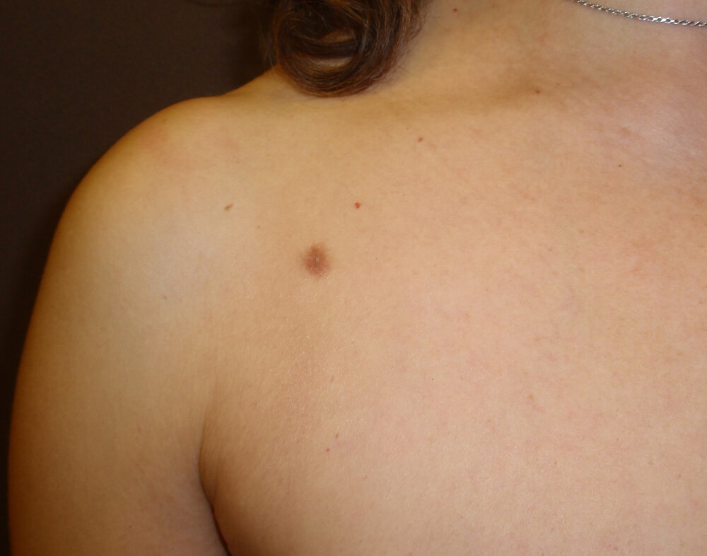 Υπεράριθμη Θηλή