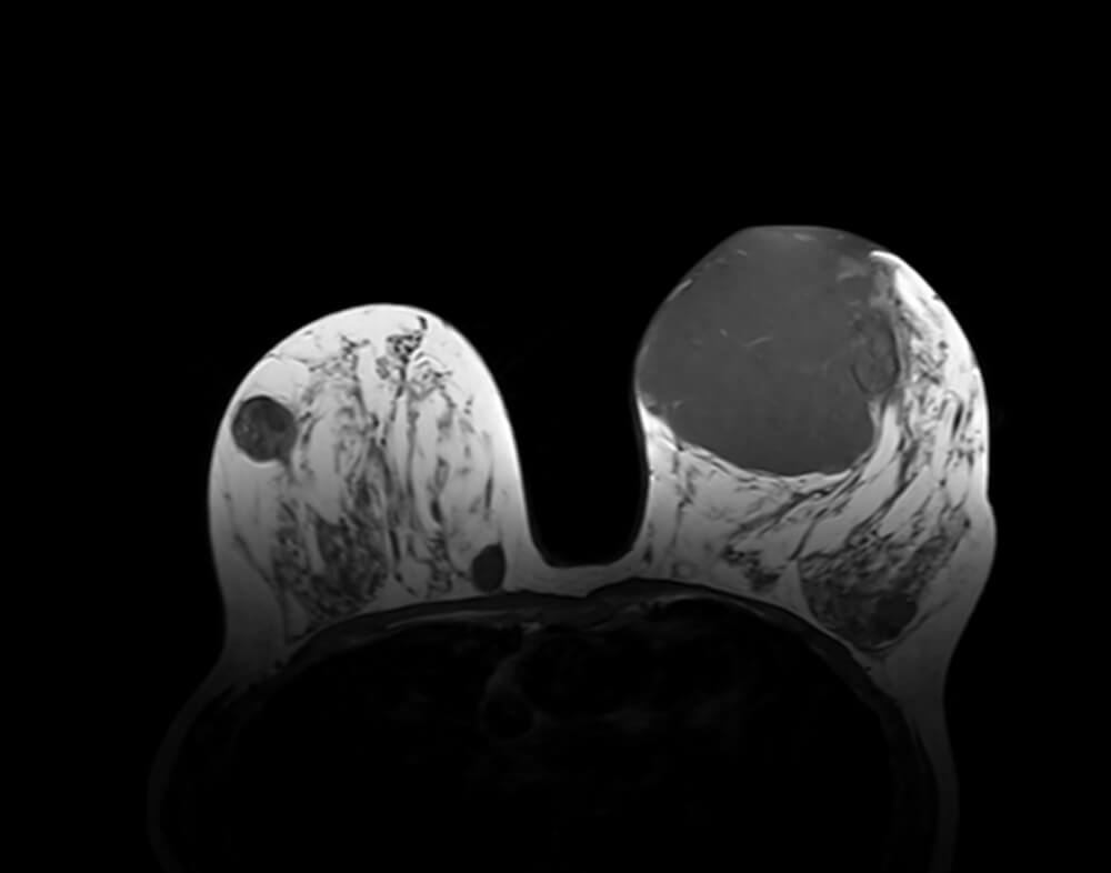 Καλοήθης Φυλλοειδής Όγκος