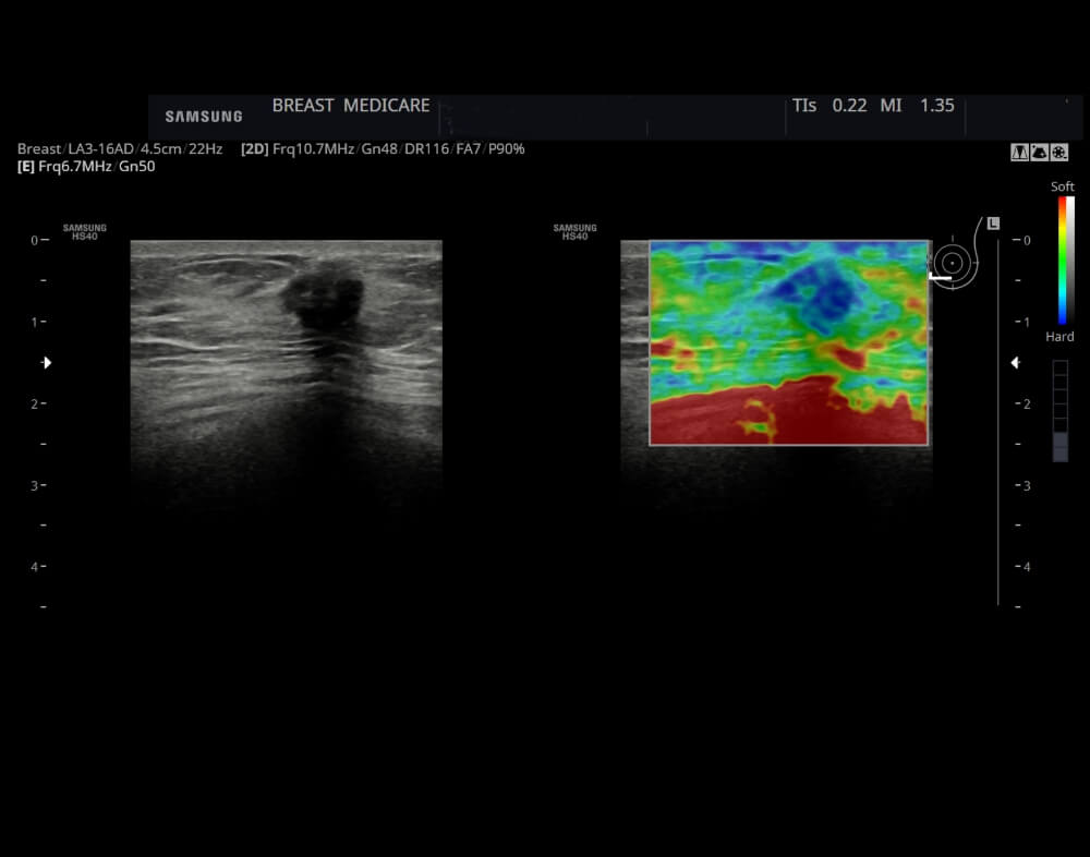 Όγκος από Κοκκώδη Κύτταρα
