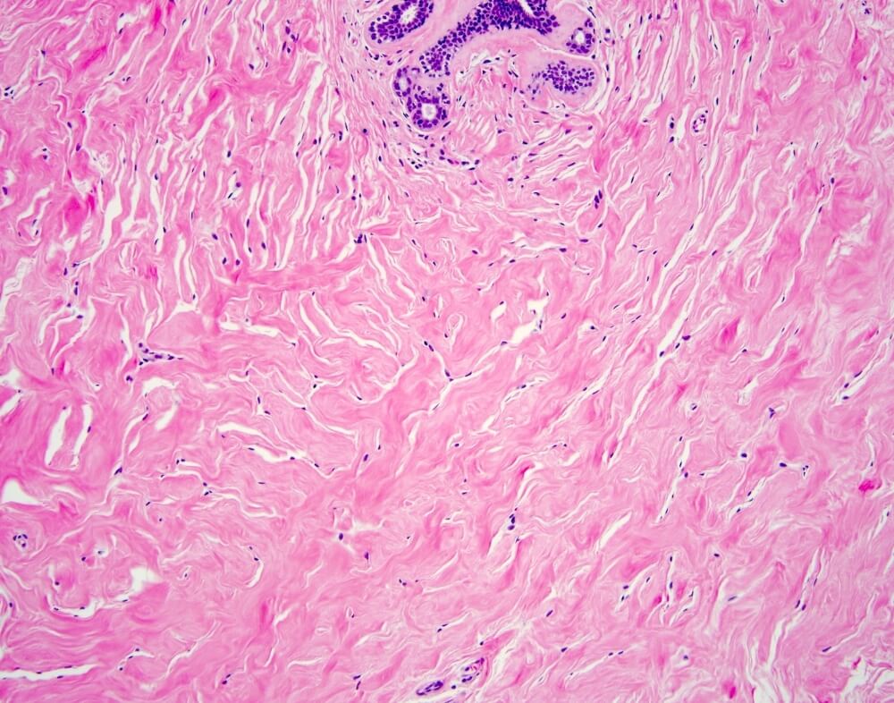 Ψευδοαγγειωματώδης στρωματική υπερπλασία (PASH)